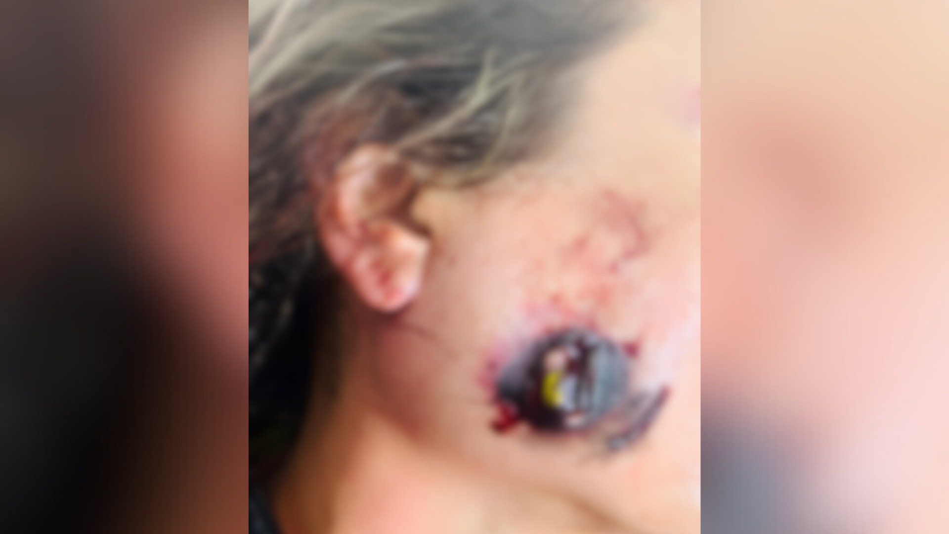 Mulher atingida no rosto por bala de borracha após Carnaval não consegue abrir a boca e pode passar por cirurgia de risco em MG