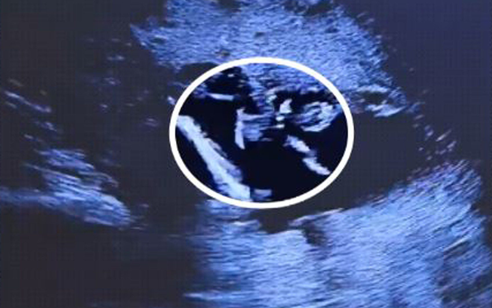 Vídeo de ultrassom mostra bebê ‘chutando’ DIU na barriga de mamãe influenciadora