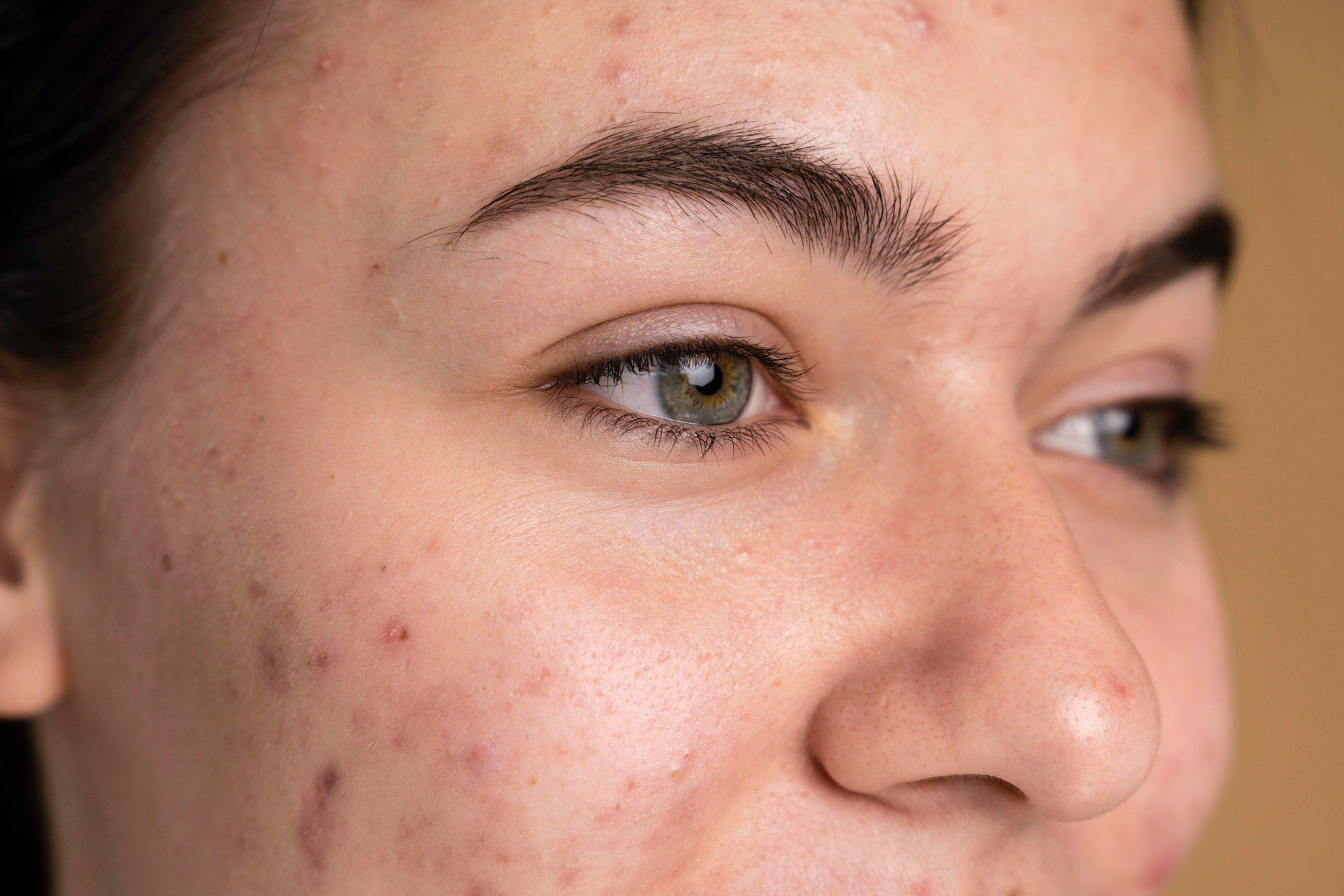 Roacutan contra acne: remédio usado por Ana Castela tem restrições; entenda quem deve usar e os riscos