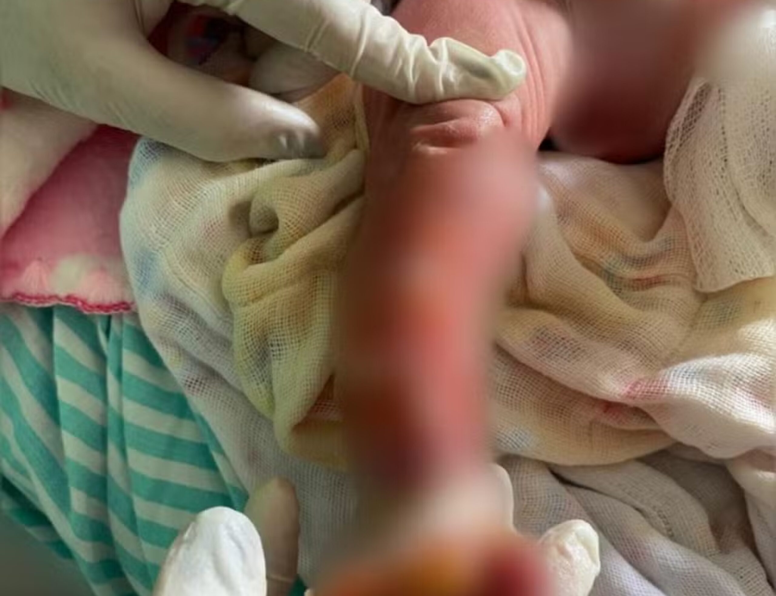 Recém-nascida internada na UTI após banho em maternidade deve se transferida para hospital especializado em queimados