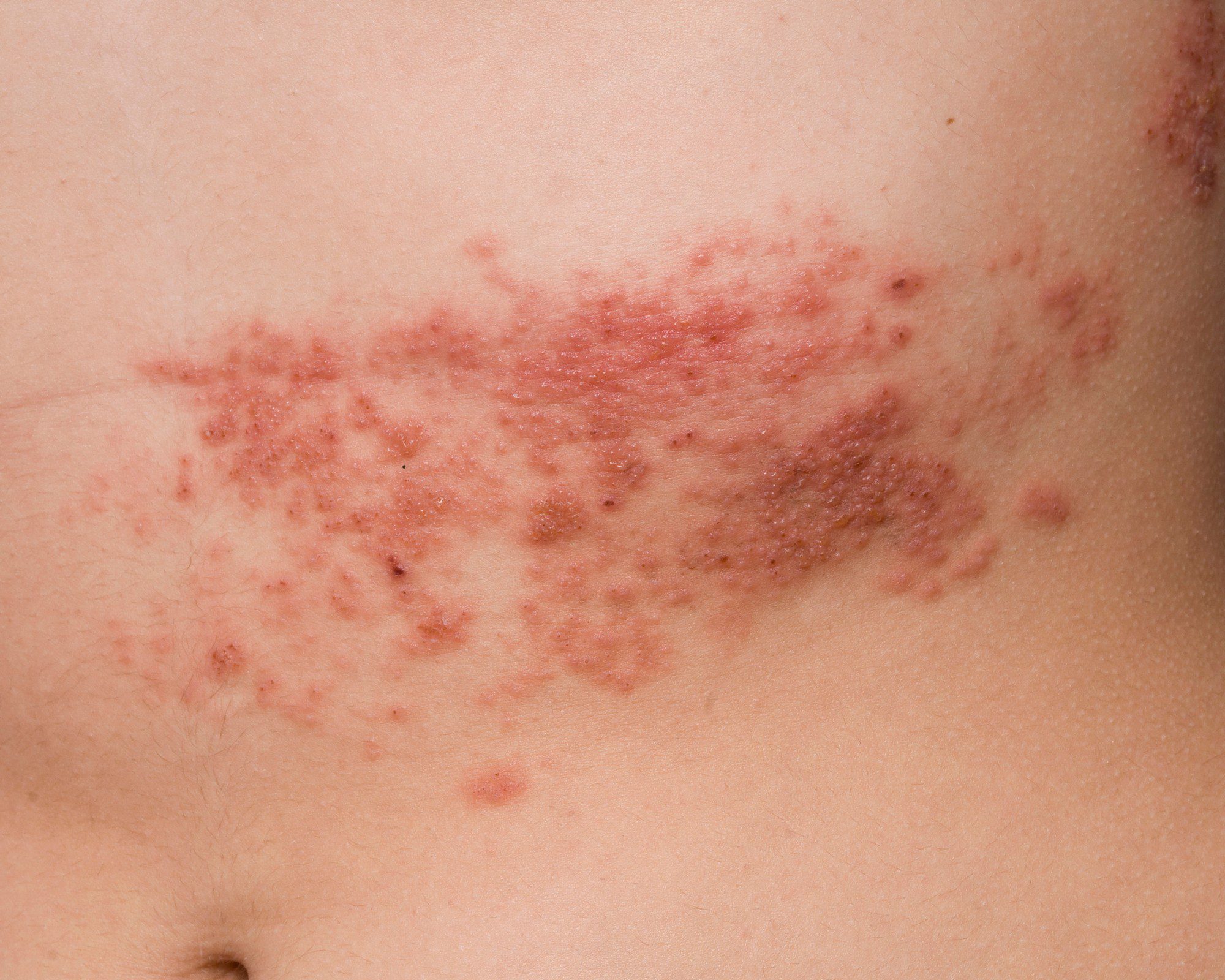 Herpes-zóster: conheça causas, sintomas e tratamento