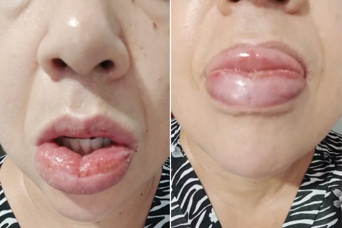 Mais de 1,2 mil pessoas relataram reação à pasta da Colgate; venda segue proibida