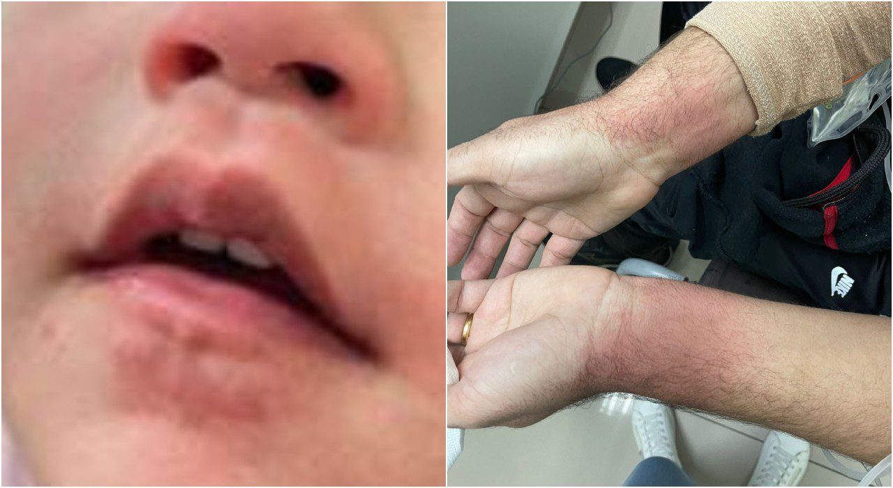 Insegurança, revolta’, diz pai de menina de 2 anos após justiça soltar médica suspeita de atacar família com spray de pimenta